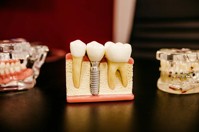 Dental implant model