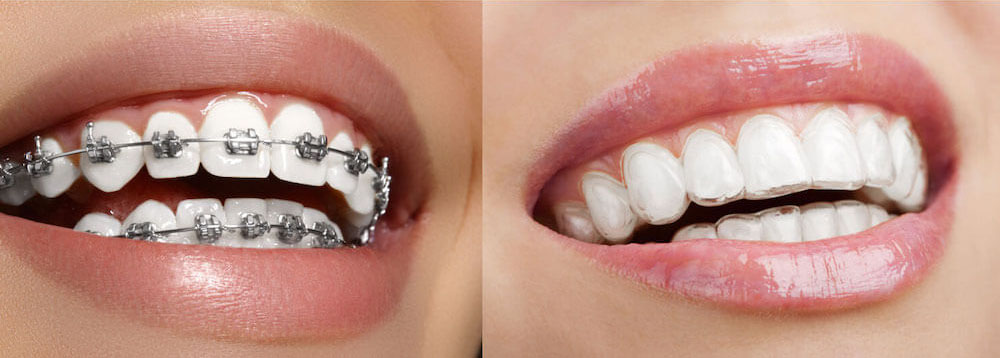 Invisalign vs metal braces