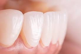 Veneer