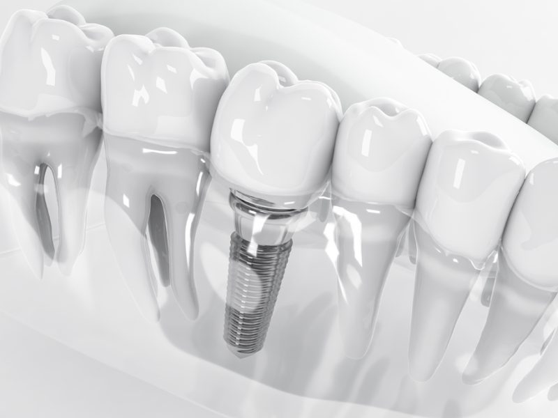 Dental Implants | Smile Club | Dentist in Cheadle Hulme | General Dentistry